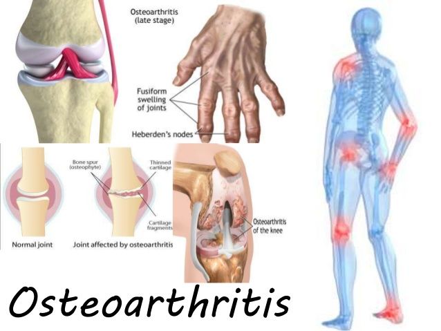 Nyeri Tulang Sendi Akibat Osteoarthritis